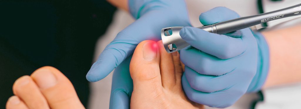 laser podologiczny diodowy podczas zabiegu